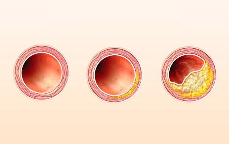 vascular atherosclerosis